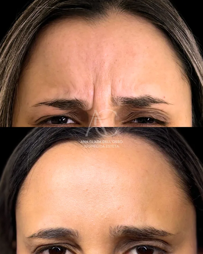 Antes e depois de aplicação de toxina botulínica nas linhas da glabela