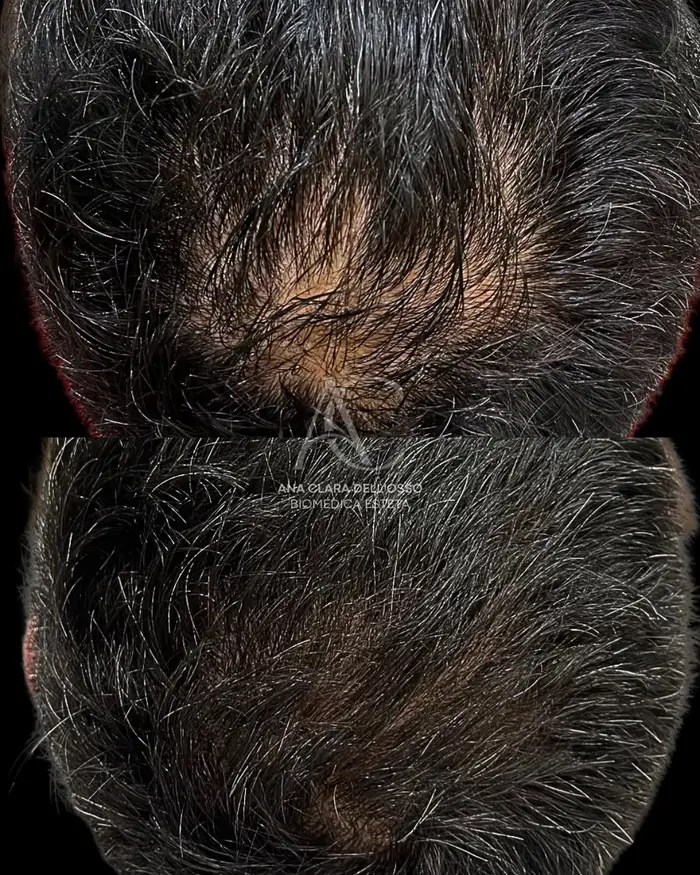 Antes e depois de tratamento capilar no couro cabeludo
