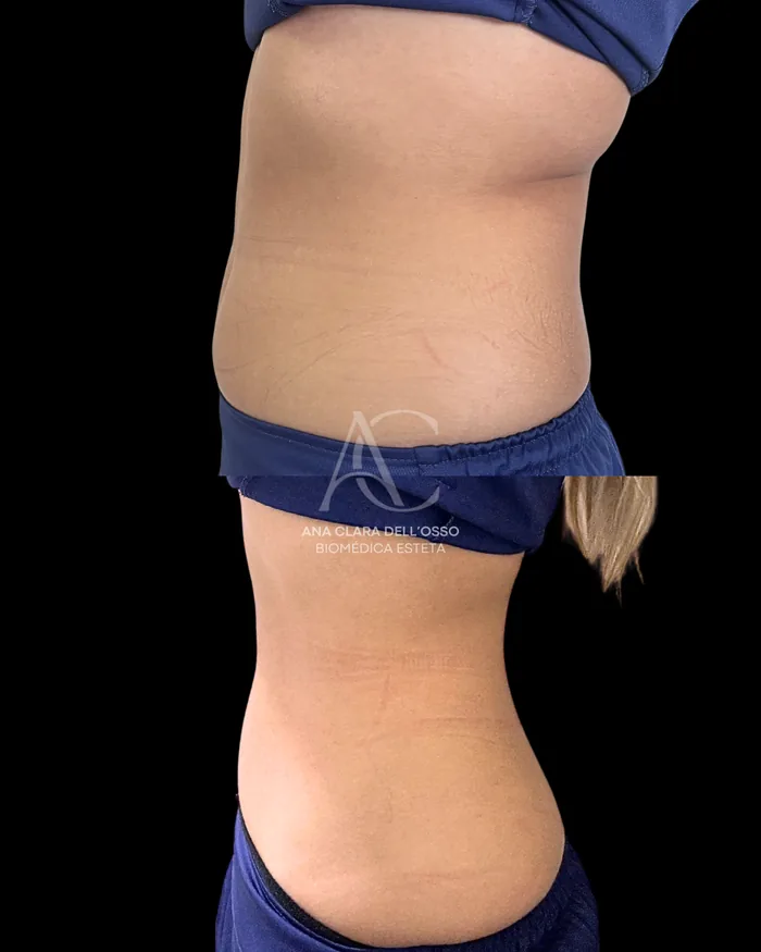 Antes e depois de tratamento enzimático na região abdominal