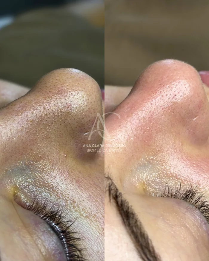 Antes e depois de limpeza de pele