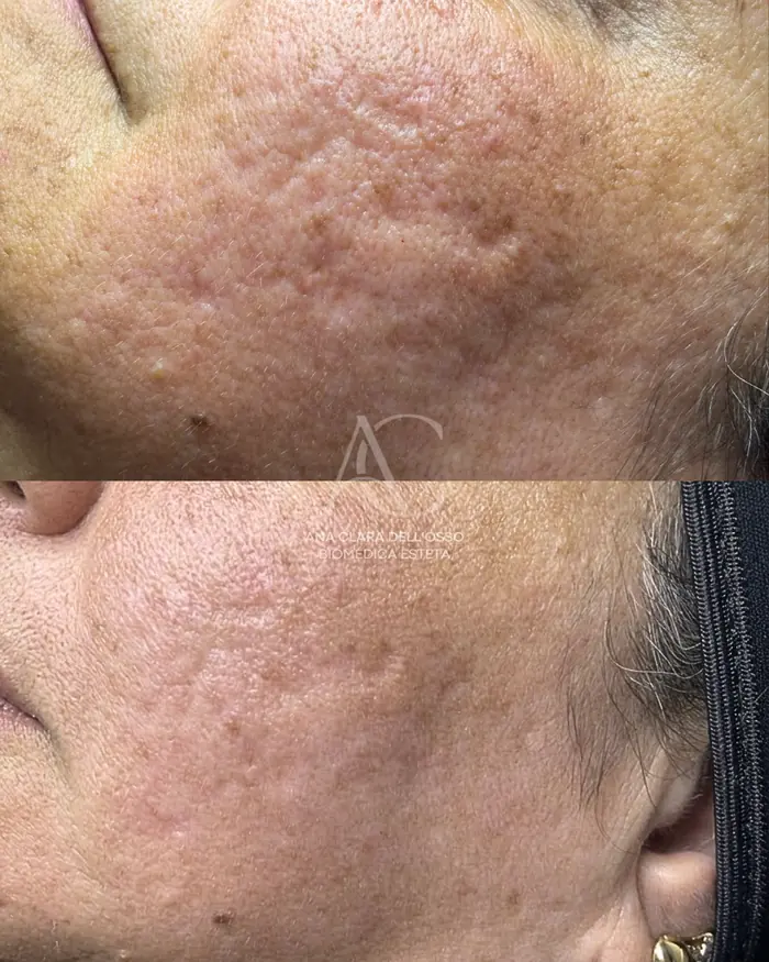 Antes e depois de microagulhamento em cicatrizes de acne na região da bochecha