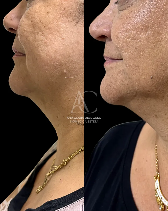 Antes e depois de tratamento enzimático na papada