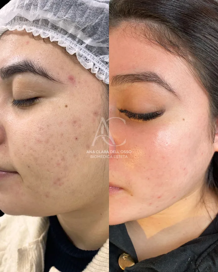 Antes e depois de peeling no tratamento de acne