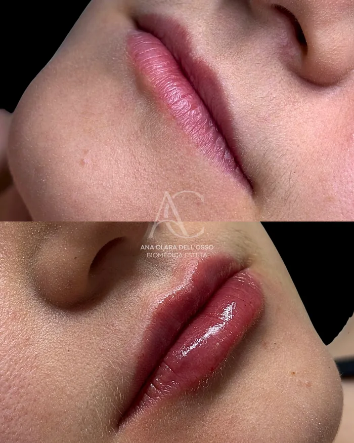 Antes e depois de preenchimento labial com ácido hialurônico