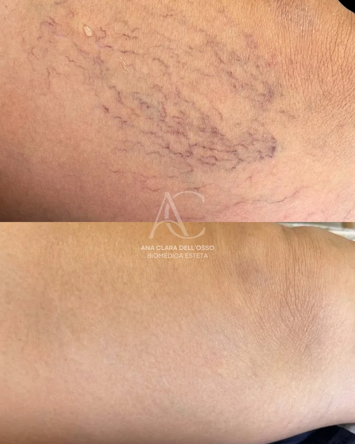 Antes e depois de aplicação para microvasos na perna